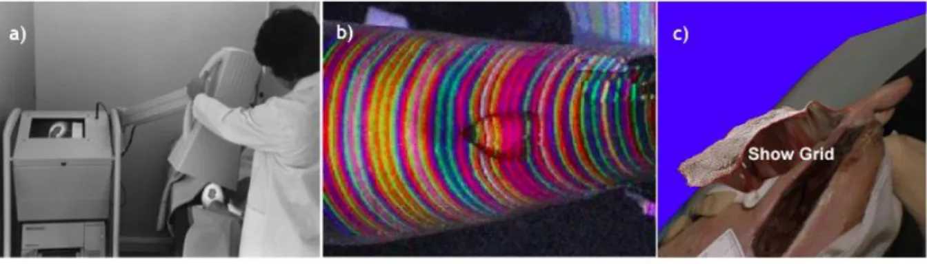 Figure 2.11- Structured Light a) The MAVIS b) The Structured Light method c) 3-D representation of the area  and volume of the ulcer (Krouskop et al., 2002; MAVIS II, 2006)