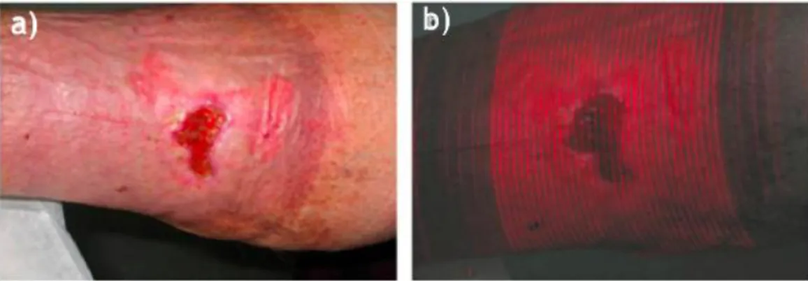 Figure 2.14- Methodology created by (Kecelj Leskovec et al., 2007) a) Visual images captured by the camera  and b) Wound being illuminated by light stripes