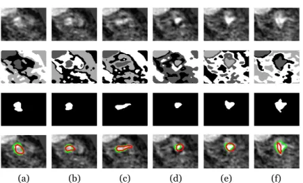 Fig. 2 Examples of segmentation results obtained from the postcontrast 3D-T1W images: The input MR images are shown in the first row
