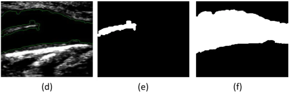 Figure  4:  Lumen  edges  identification:  (a)  Cropped  image  in  grayscale;  (b)  Resultant  image  after  the  application of an anisotropic diffusion filter for speckle  noise removal; (c) Image after the application of the  Sobel edge detector; (e) O