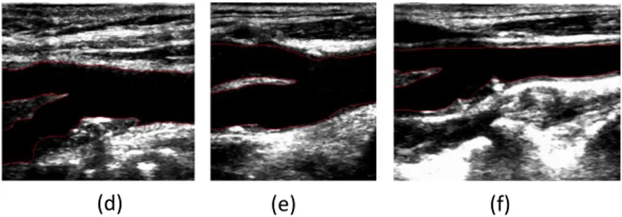 Figure 6: Examples of the segmentation of the lumen and bifurcation boundaries of the carotid artery  achieved by our method in 6 B-mode ultrasound images