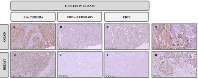 Figure  3.1  –  Immunohistochemistry  analysis  of  E-SL  expression  in  cancer  tissues