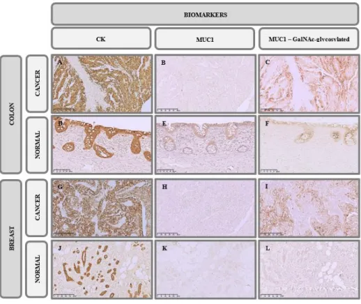 Figure  3.3  -  Immunohistochemistry  analysis  of  CK  and  MUC1  expression  in  cancer  tissues