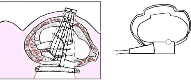 Figura  2.1  –  Representação  da  monitorização  externa  (à  esq.)  e  do  eléctrodo  (à  dir.)  que  permite  detectar as contracções uterinas e a frequência fetal.