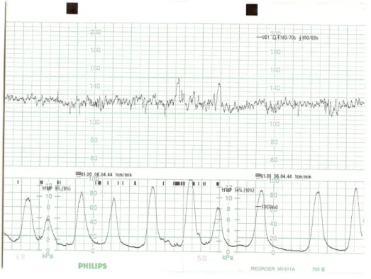 Figura  2.3  –  Cardiotocograma  –  traçado  típico  registado  durante  o  trabalho  de  parto
