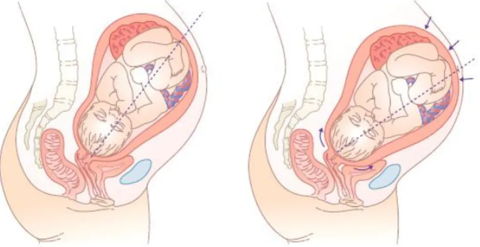 Figura 2.7 – Mudança de  direcção do  eixo uterino  e fetal  durante as contracções no trabalho  de  parto [26]