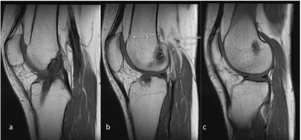 Figura 1 - Três cortes sagitais de RM; a - visível o tecto da fossa intercondilar do  fémur (linha de Blumensaat); b - visível o centro do túnel ósseo; c - limites do  côndilo lateral do fémur