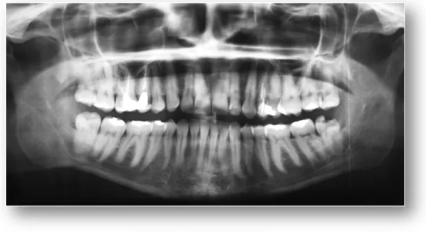 Figura 10 - Dente 38 com indicação de extracção devido a extensa cárie no 3M (caso clínico do IV MCO)