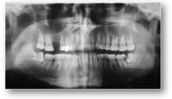 Figura 11 - Exemplo de cárie na face cervico-distal do dente 37 (caso clínico do Serviço de Cirurgia Oral)