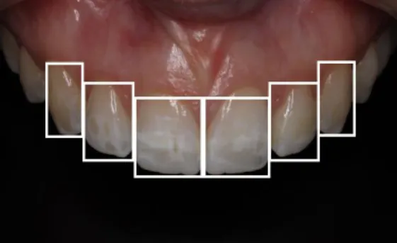 Figura  3  -  Simetria  dos  dentes  ântero-superiores  verificada no sorriso da paciente
