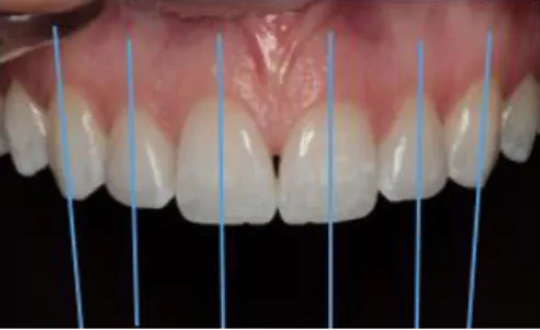 Figura  5-  Inclinação  dos  eixos  dentários  observada no sorriso da paciente