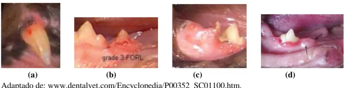 Figura 16. Aparência clínica de FORL (a) Estadio II – Lesão no esmalte e na dentina. (b) Estadio III  – é necessário um exame radiográfico para verificar envolvimento do canal pulpar