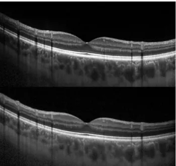 FIGURE 2. Registered vertical B-scans centered on the fovea at rest and during Valsalva maneuver