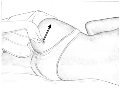 Figura 4: Manobra de traço. 