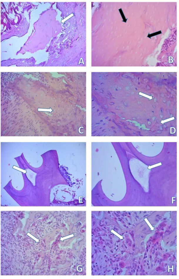 Figura 5- Grupo ZST com exodontia. Sequestro (seta branca) 5X (A) com áreas de osteonecrose, com  lacunas vazias (setas pretas) 20X (B) Esvaziamento de cementoplastos (setas brancas) 20X (C) e 40X  (D) Necrose pulpar (seta branca) 5X (E) e 10X (F)