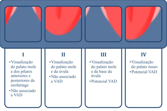 Tabela 2 – Classificação de Mallampati: visualização da orofaringe e respectiva relação com a VAD 4 