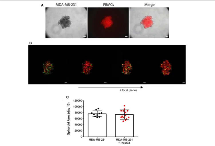 FIGURE 3 | Patient-derived immune cells are able to infiltrate the 3D spheroid of MDA-MB-231 breast cancer cell line