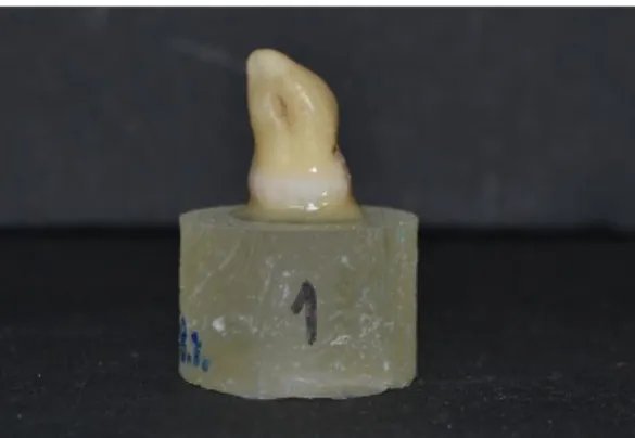 Figure 3 - Tooth attached to an acrylic holder with  sticky wax.