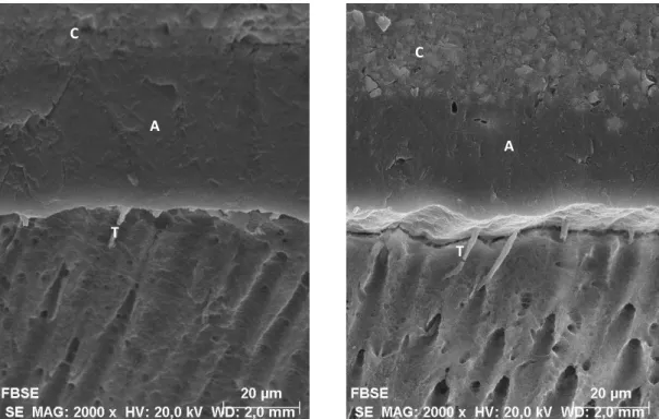Figure  12  –  SEM  micrograph  of  resin-dentin  interface  formed  with  Futurabond  M+  under  the  SE  mode,  without  pulpal  pressure  at  2000x  magnification