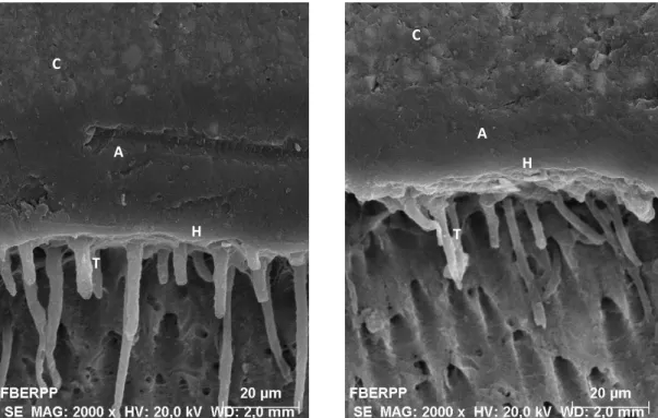 Figure  13  –  SEM  micrograph  of  resin-dentin  interface  formed  with  Futurabond  M+  under  the  ER  mode,  with  pulpal  pressure  at  a  2000x  magnification