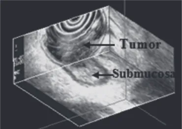 Fig. 2. RC staging by 3D-EUS with invasion of the  submucosa but without surpassing it, as confirmed by  the surgical sample