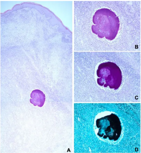 Figure 2. Photomicrographs of the skin biopsy. A – abundant granulation tissue with associated mixed inflammatory  infiltrate extending until the deep dermis, with areas of abscess formation
