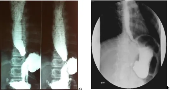 Figura 5  –  Caso 2: a)  Trânsito esofágico inicial com dilatação esofágica  e  paragem da  progressão do contraste na transição esofagogástrica;  b)  Trânsito esofágico de controlo  após miotomia sem evidência de obstrução