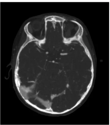 Fig. 2.  CT angiogram demonstrated a thrombus in the M1 segment of the left MCA. 