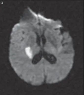 Figure 1  CT, diffusion-weighted imaging and ADC maps. 