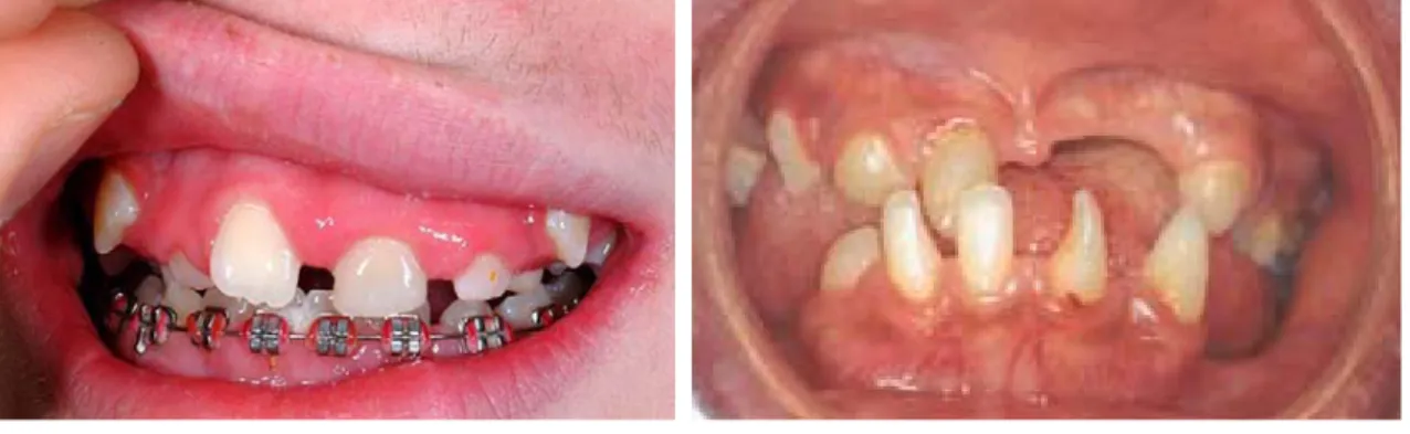 Figura 2: Ausência de alguns  dentes decíduos – 62, 74 e 75 – e  presença de dentes conóides em  criança de 3 anos do sexo  feminino (Kitakawa et al., 2009).