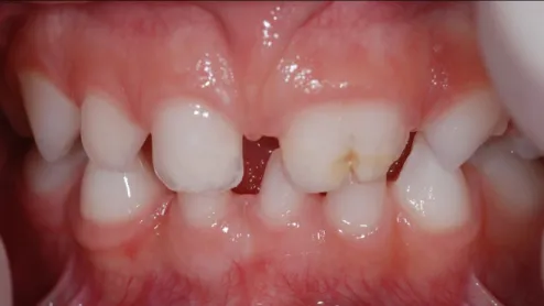 Figura 7: Fotografia intra-oral frontal da paciente (realizada dia  15 de Maio de 2010)