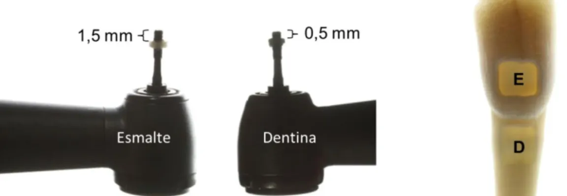 Figura 1: Imagem ilustrativa da confecção dos preparos cavitários com margem em esmalte    (E) e  dentina (D).