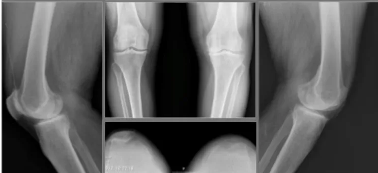 Figura 1: Gonartrose esquerda, grau IV na classificação Kellgren- Kellgren-Lawrence.