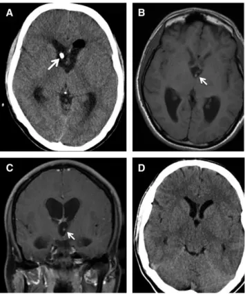 Figura  4  –  Apresentação  imagiológica  de  neurocisticercose  no  terceiro  ventrículo,  submetida a neuroendoscopia