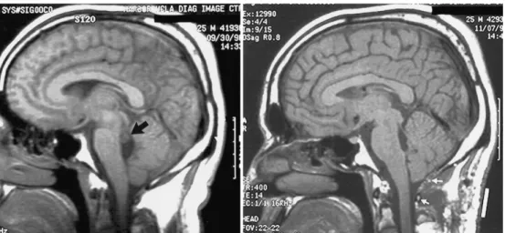 Figura  5  –  Apresentação  imagiológica  de  neurocisticercose  no  quarto  ventrículo,  submetida a neuroendoscopia