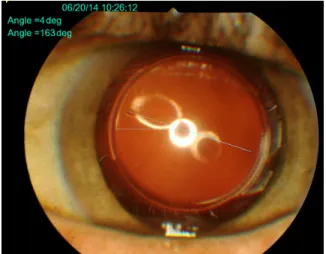 Figure 1 Postoperative digital analysis of Precizon ®  toric iOl rotation.