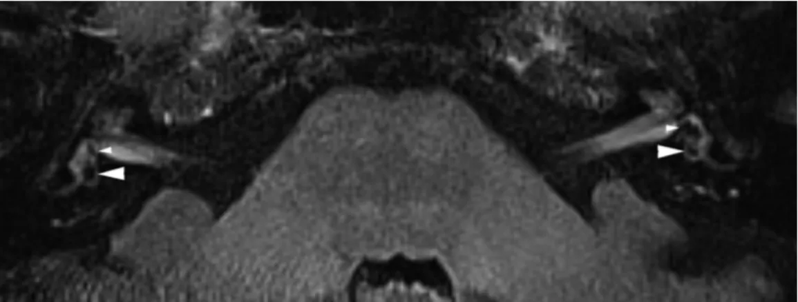 Figura 7: Mulher de 67 anos diagnosticada com DM definitiva pelos crit´ erios de Bar´ any 2015, confinada ao ouvido esquerdo