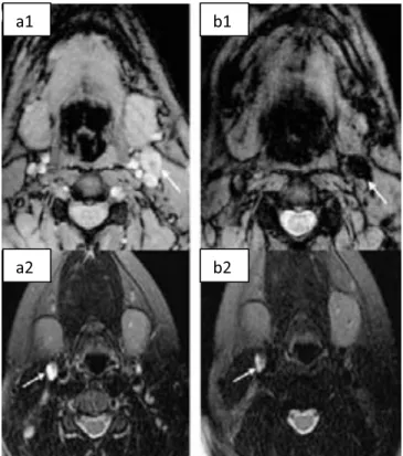 Figura 1-2 - Ressonância magnética do crânio de voluntários antes (a1 e a2) e depois (b1  e b2) da injeção de FM
