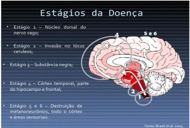 Figura  4  -  Estágios  da  doença  de  Parkinson  proposto  por  Braak  e  colaboradores,   demonstrando  as  regiões  atingidas  pelas  lesões,  que  se  iniciam  pela  medula  e  tronco  olfatório  do  nervo  vago  e  seguem  pelo  tronco  encefálico  a