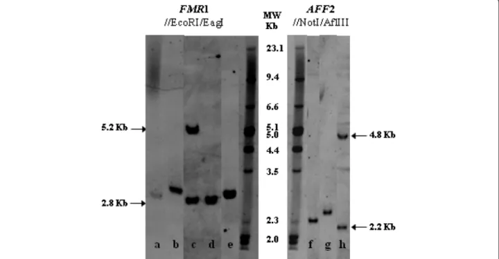 Figure 2 Examples of Southern blot results. Genotyping using FMR1 probe: After EcoRI /EagI double digestion, normal females exhibit two fragments, a ~2.8 kb (active X) and a ~5.2 kb (inactive X), while in normal males only a ~2.8 kb fragment is seen: (a) F