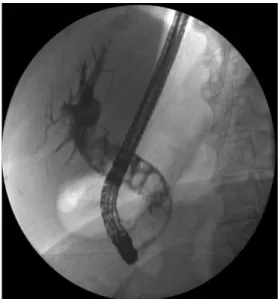 Fig. 1. Cholangiography: dilated common bile duct  up to 20 mm and multiple (> 10) stones.
