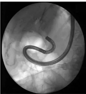 Fig. 2. Fluoroscopic appearance of direct peroral  cholangioscopy with the tip of endoscope inside the  common bile duct (air cholangiography)