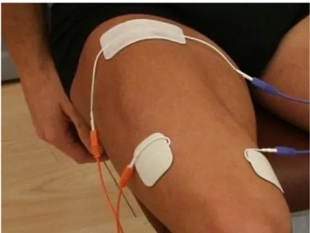 Figura 5:  Posicionamento dos eletrodos durante a aplicação da EENM  sobre a região da musculatura do quadríceps