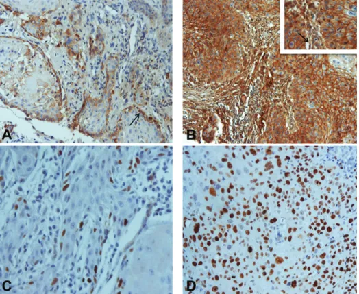 Figure 1: Immunohistochemical expression of EMMPRIN and Ki-67 in oral squamous cell carcinomas: (A) EMMPRIN score 1+ expression with predominantly peripheral distribution pattern (arrow) (×200); (B) EMMPRIN score 3+ expression with staining homogeneously d