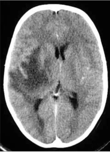 Figura 1a. Caso 1. TAC inicial con contraste. Extensa lesión hipodensa frontotemporal derecha, predominantemente de la sustancia blanca, pero que se extiende hacia el núcleo lenticular y el tálamo