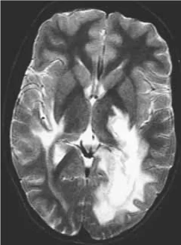 Figura 2b. Caso 1. RM axial ponderada en T 2 . Control dos meses des- des-pués del segundo brote, que revela aspectos residuales de ambas  lesio-nes, con una buena recuperación de la lesión izquierda.