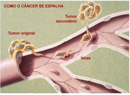 Figura 3 – Proliferação de tumores malignos – Metástase. 