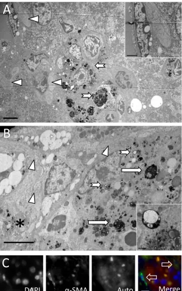 Fig. 7. Detection of collagen-producing cells at necroinﬂammatory foci. (A) Electron micrograph of a sideronecrosis focus in a middle-aged Hfe/Nrf2 -/- mouse liver displaying the accumulation of products of cell degeneration within hepatic phagocytes (arro