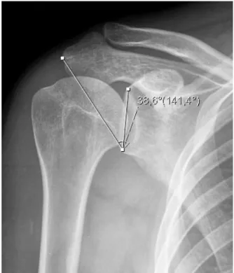 Figura  2:  Aferição  do  ângulo  crítico  do  ombro  na  radiografia  anteroposterior  do  ombro