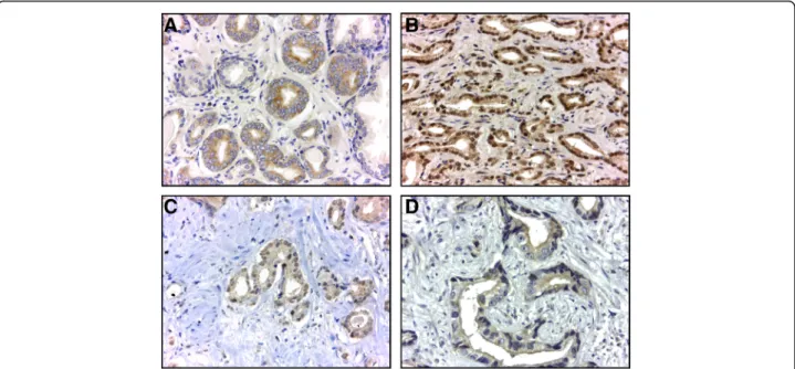 Fig. 2 Frequency of patients with positive staining in benign (BPH) and malignant (organ-confined and extra prostatic disease) epithelial cells.